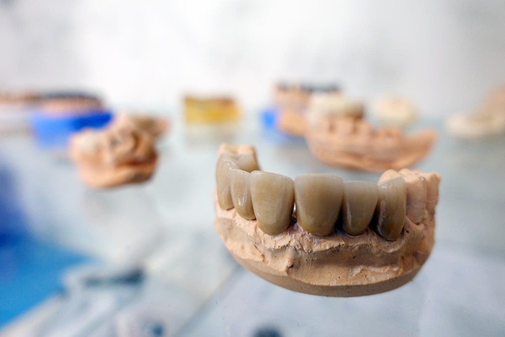 Implanturi dentare: O soluție durabilă pentru zambetul perfect